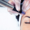 micro needling