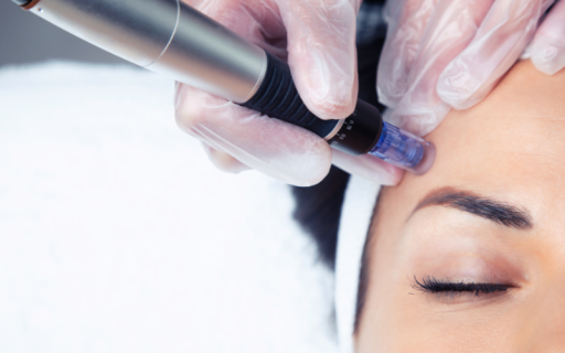 micro needling