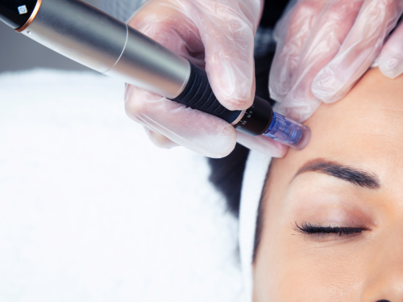 micro needling
